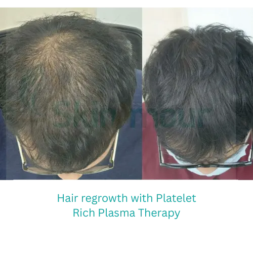 PRP therapy for hair, Dr. Yogesh Kalyanpad