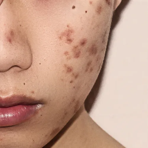 acne & acne scar treatment