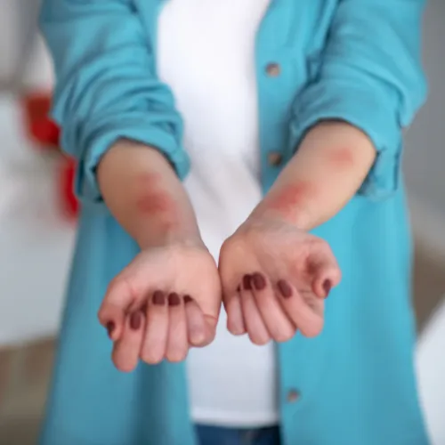 Allergies - clinical dermatology
