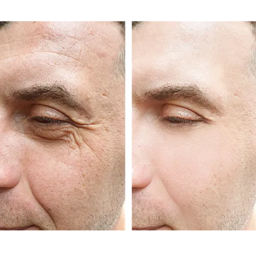 Botox