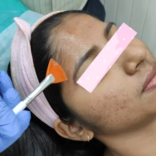 Chemical Peel