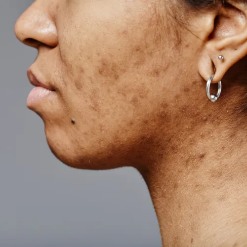 skin issues treated by chemical peel