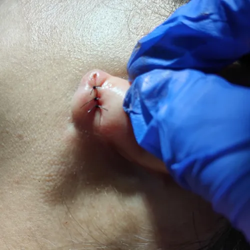 ear lobe repair