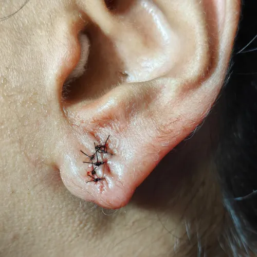 Ear Lobe Repair