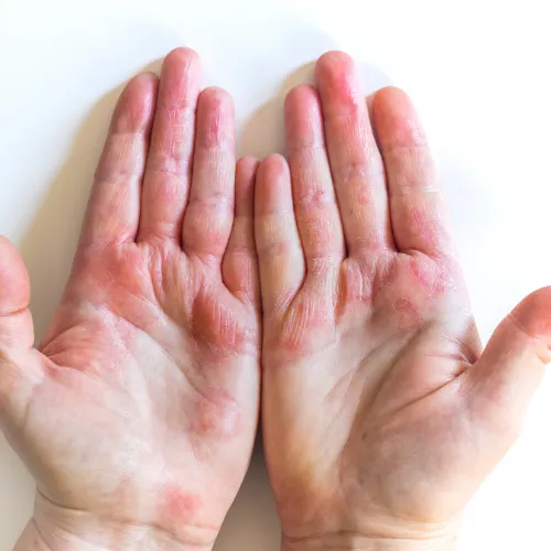 Eczema