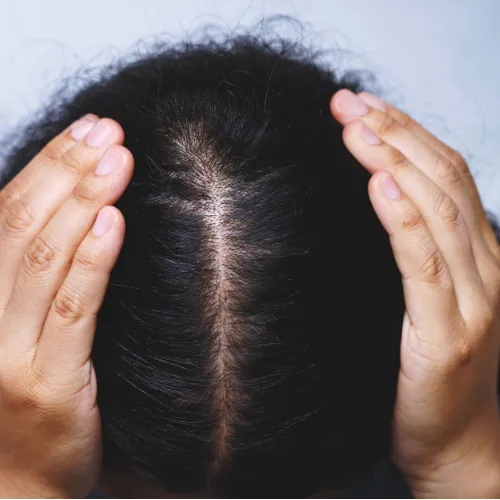 mesotherapy by Dr. Yogesh Kalyanpad