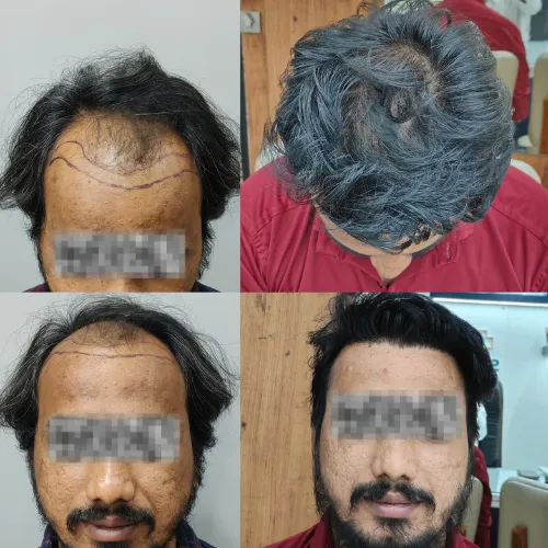 hair transplant result