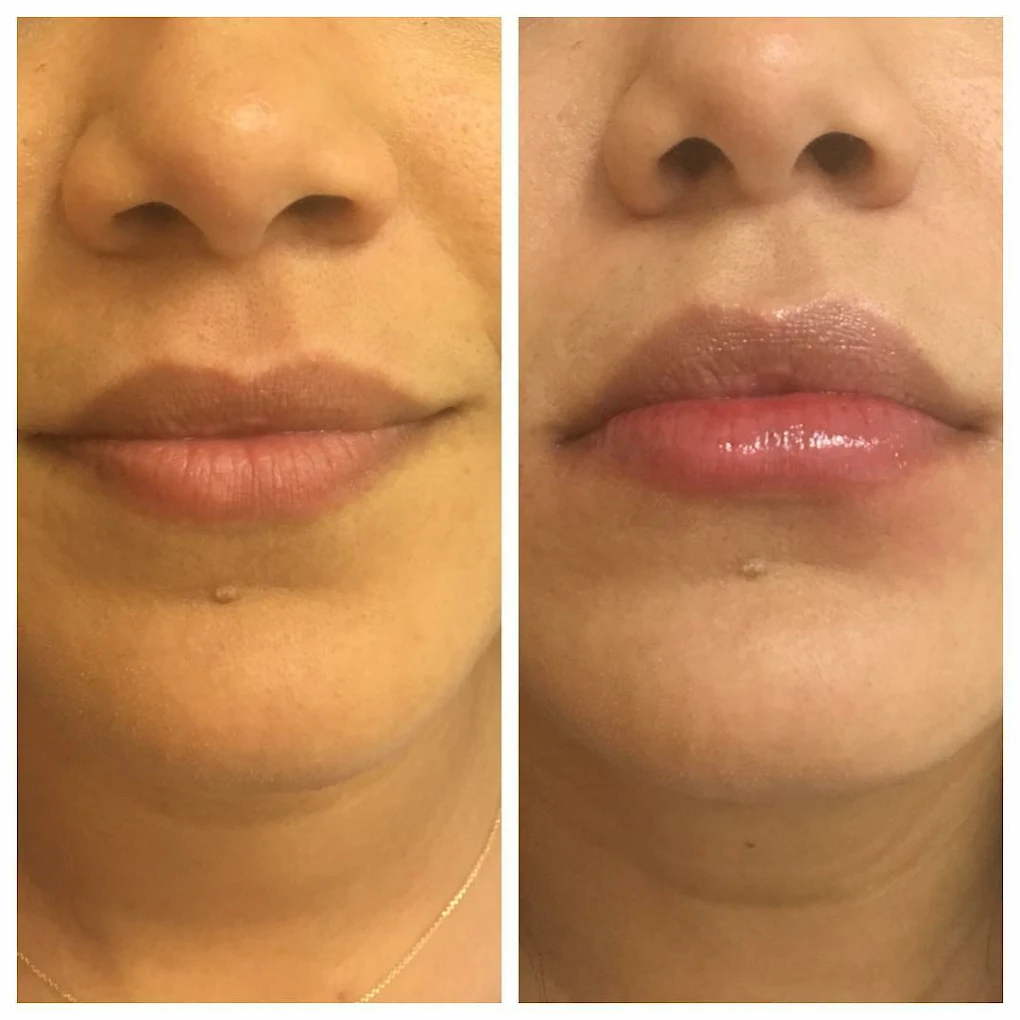 lip dermal fillers by Dr. Yogesh kalyanpad