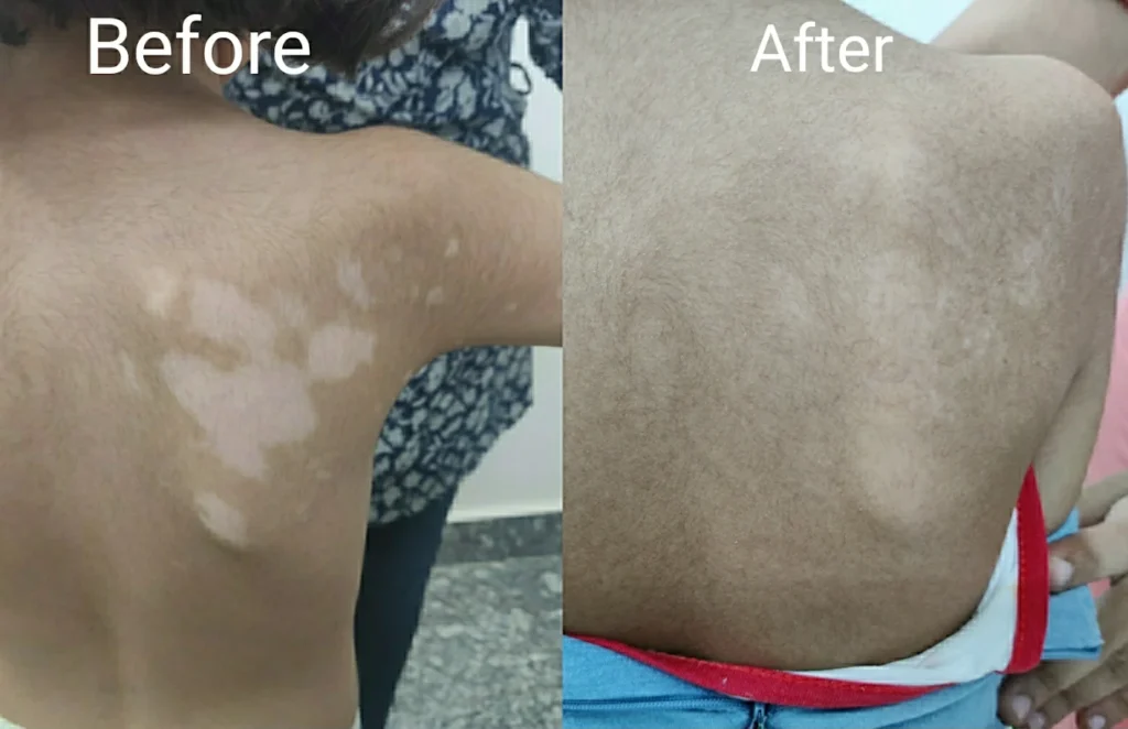 Vitiligo treatment with Dr. Yogesh Kalyanpad