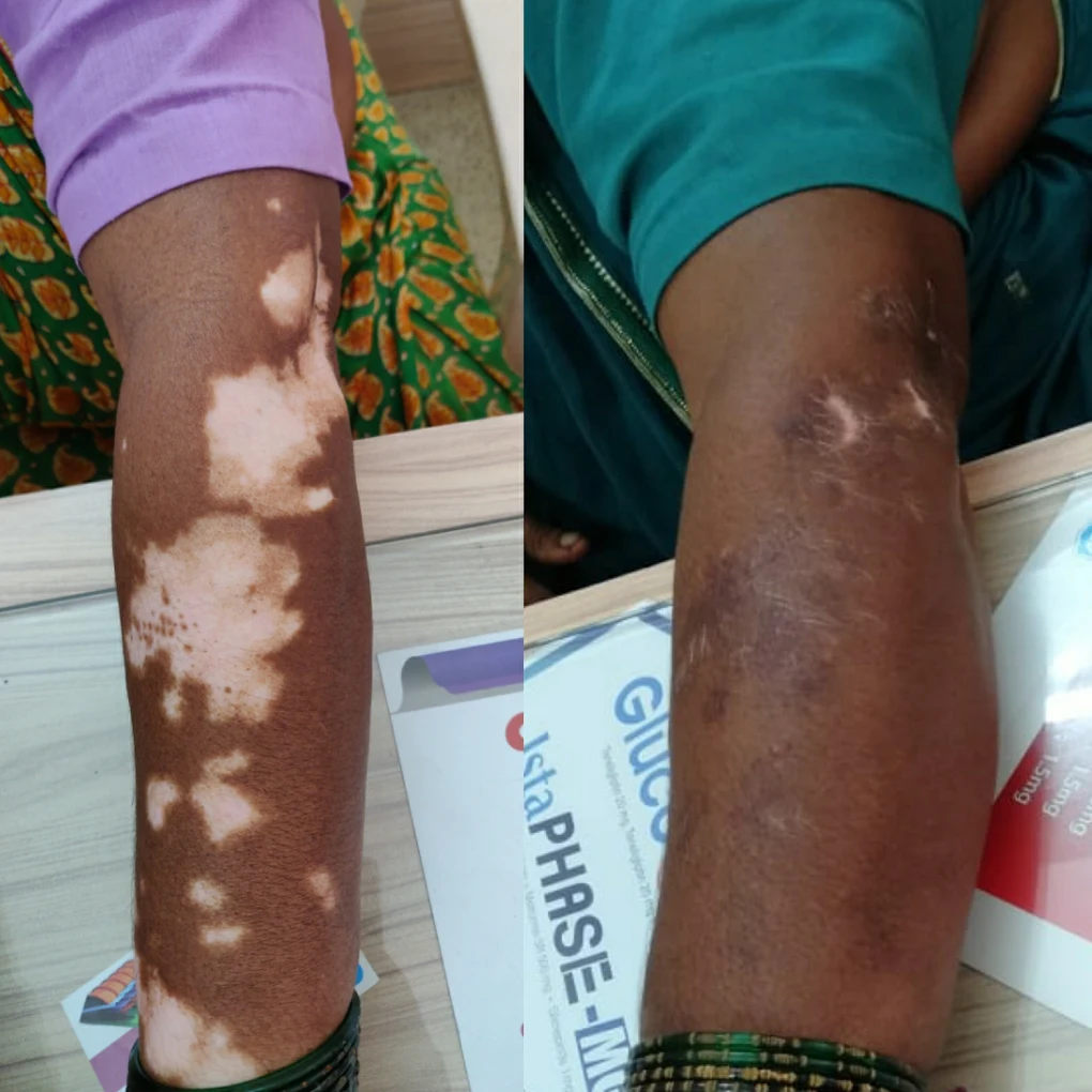 Vitiligo treatment with Dr. Yogesh