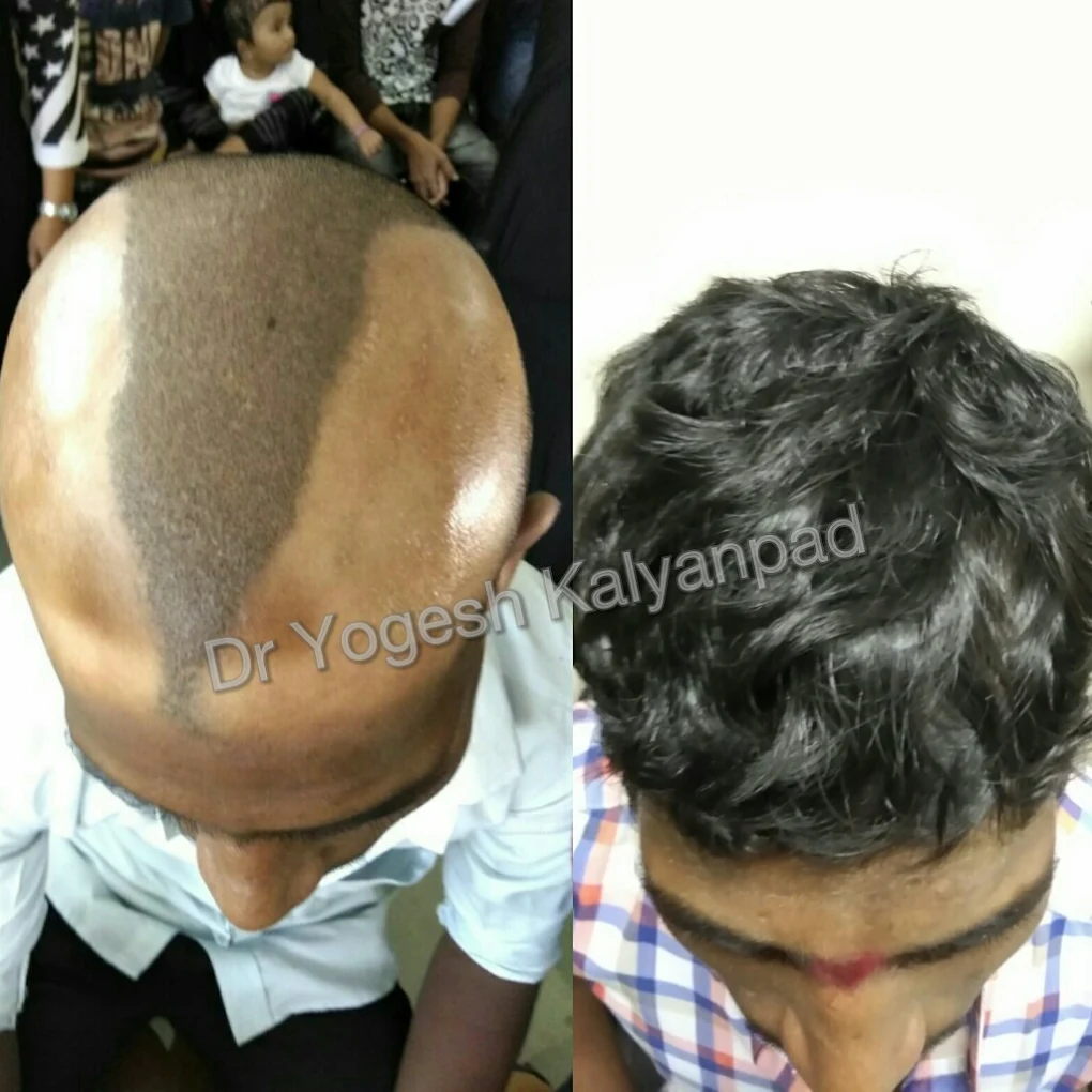 stem cell mesotherapy, Dr. Yogesh Kalyanpad
