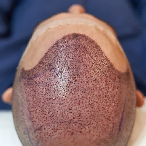 Scalp Micropigmentation
