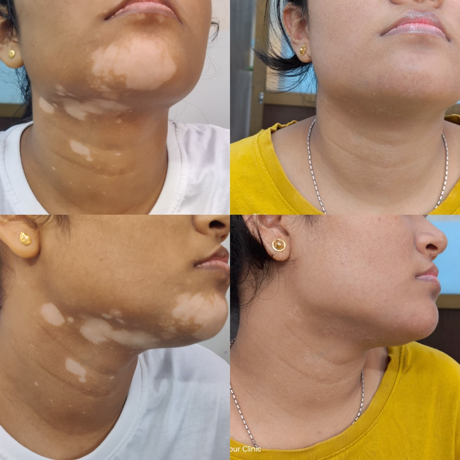 Vitiligo Treatment