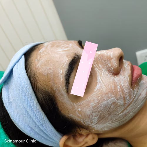 Chemical peels @ SkinAmour